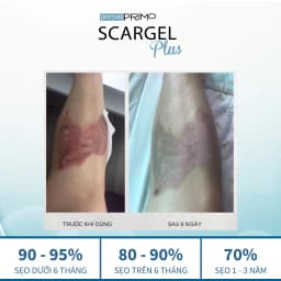 Thumbnail Kem Làm Mờ Sẹo DottorPrimo Scargel Plus - Duy Nhất Dùng Được Khi Vết Thương Còn Ướt 3