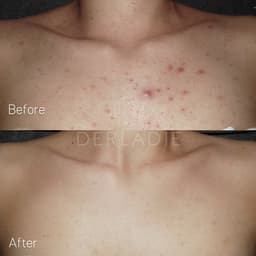 Thumbnail Xà Phòng Derladie - Xà Bông Cục Giảm Mụn Lưng Cơ Thể Derladie Body Cleansing Bar Blemish Skin 50gr 3
