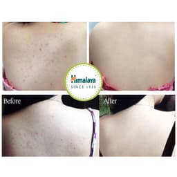 Thumbnail [MUA 8 TẶNG 2] Xà phòng giảm mụn cơ thể từ lá neem Himalaya Neem Turmeric Soap 75g/ hộp 2
