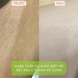 Thumbnail Kem ngăn ngừa và phục hồi rạn da giữa thai kỳ Palmer's 125g 3