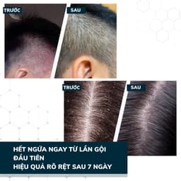 Thumbnail Dầu Gội Sạch Gàu Nấm DEGO PHARMA 80ml Dứt Điểm Gàu Ngứa & Nấm Da Đầu Sau 1 Tuần 2