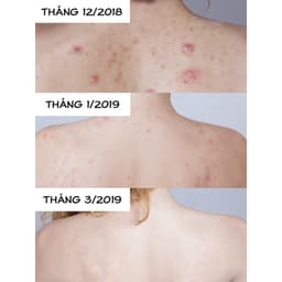 Thumbnail Combo 3 xà phòng làm sạch mụn lưng Himalaya Neem&Tumeric Soap 75g/sản phẩm 3