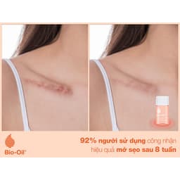 Thumbnail Tinh Dầu Rạn Da, Mờ Sẹo Bio-Oil Scar Treatment Cocolux 3