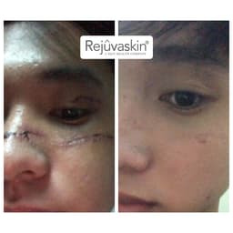 Thumbnail Combo chăm sóc da Rejuvaskin ngăn ngừa và xoá bỏ mọi loại sẹo 30ml x 15ml 4