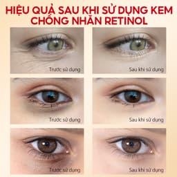 Thumbnail Kem Dưỡng Mắt VIBRANT GLAMOUR Retinol Gấp Đôi, Giảm Nếp Nhăn & Mờ Vết Chân Chim & Giảm Quầng Thâm & Nuôi Dưỡng Và Phục Hồi Sâu Vùng Da Quanh Mắt 20g 1