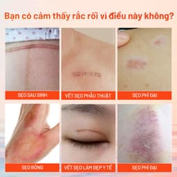 Thumbnail MeiYanQiong Kem sẹo Giảm Sẹo lồi/lõm/sẹo thâm do mụn/phục hồi các tổn thương trên da/thúc đẩy tái tạo da 15ml 2