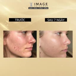 Thumbnail Viên uống ngăn ngừa mụn Image Skincare HUSH & HUSH Skincapsule Clear+ 60 viên 3