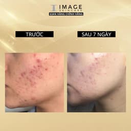 Thumbnail Viên uống ngăn ngừa mụn Image Skincare HUSH & HUSH Skincapsule Clear+ 60 viên 4