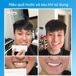 Thumbnail Bộ Kit tẩy trắng răng Smilee Max sử dụng tại nhà - Hàng chính hãng 2