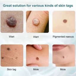 Thumbnail Kem tẩy nốt ruồi dạng đặc EELHOE Apgar loại bỏ da chết hỗ trợ giảm mụn cóc hiệu quả mạnh 2