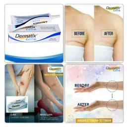 Thumbnail Dermatix gel Hỗ trợ giảm sẹo 100% Chính Hãng 15g 4