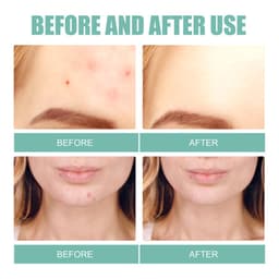 Thumbnail Set 132 Miếng Dán Hỗ trợ giảm mụn EELHOE Cao Cấp 3