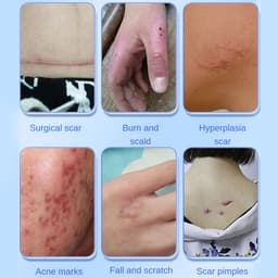 Thumbnail Kem Hỗ trợ giảm sẹo / Vết Bỏng Hiệu Quả 4