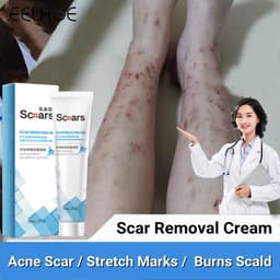 Thumbnail Kem Hỗ trợ giảm sẹo / Vết Bỏng Hiệu Quả 1