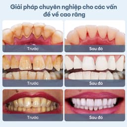 Thumbnail Máy lấy cao răng CKEYIN KQ158W loại bỏ vi khuẩn/vết ố/làm sạch răng nướu kèm 2 đầu làm sạch thay thế tại nhà 4