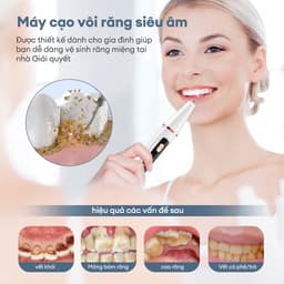Thumbnail Máy lấy cao răng CKEYIN KQ158W loại bỏ vi khuẩn/vết ố/làm sạch răng nướu kèm 2 đầu làm sạch thay thế tại nhà 2