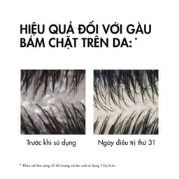 Thumbnail Bộ 2 dầu gội giúp sạch gàu dành cho da đầu dầu & ngứa Vichy Dercos Anti Dandruff 200ml x2 3