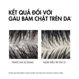 Thumbnail Dầu gội sạch gàu cho da đầu dầu, ngứa Vichy Dercos Anti Dandruff 200ml 2