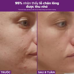 Thumbnail Tinh chất se khít lỗ chân lông tối ưu Paulas Choice Niacinamide 20% Treatment 2ml 78032 2