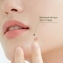 Thumbnail Chấm Mụn Rau Má Giảm Mụn Và Mờ Thâm Cỏ Mềm 10g 4
