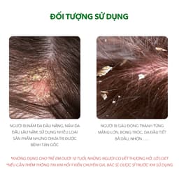 Thumbnail Combo Sản Phẩm Ezema 50 & Dầu Gội Sạch Gàu Antisol | Thương Hiệu iCare Pharma | Hỗ Trợ Trị Gàu Ngứa, Nấm Da Đầu Lâu Năm 3