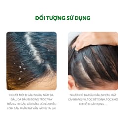 Thumbnail Combo 3 Chai Dầu Gội Sạch Gàu Antisol | Thương Hiệu iCare Pharma | Làm Sạch Gàu Nấm Ngứa Da Đầu 3