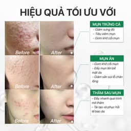 Thumbnail Serum sạch mụn giảm thâm chuyên cho bà bầu da mụn, gom khô mụn với tràm trà GUO 10ml, 30ml 4