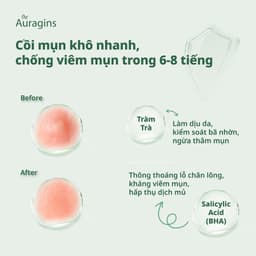 Thumbnail Miếng dán mụn The Auragins Acne Rescue Patch 2