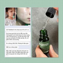 Thumbnail Bộ chăm sóc da mụn Caryophy portulaca (serum 30ml toner 300ml) 4