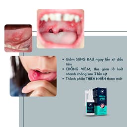 Thumbnail Xịt Dứt Điểm Nhiệt Miệng, Nhiệt lưỡi, Lở môi, Viêm Lợi Dego Pharma - Dịu Cơn Đau Loét Miệng, Hết Hôi Miệng 3
