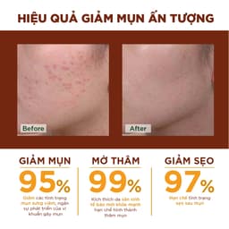 Thumbnail Kem nghệ Oriss giảm mụn và thâm không gây vàng da dành cho da dầu mụn tuýp 20gr 4