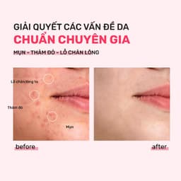 Thumbnail Bộ Đôi Kiềm Dầu, Ngừa Mụn, Thu Nhỏ LCL Serum Niacinamide 20% 30ml, Mặt Nạ Đất Sét Derladie Vegan Pink Clay Mask 3
