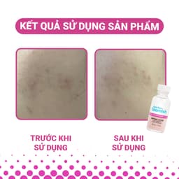 Thumbnail 2 Chấm Mụn/Thâm Mụn Bye Bye Blemish cho tất cả các loại mụn trên mặt 30ml x 2 3