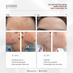 Thumbnail Bộ đôi Actinyl giảm mụn nội tiết, mụn sưng viêm Actinyl Duo 4