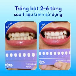 Thumbnail Bộ Kit Trắng răng Smilee Extra - Phiên bản nâng cấp làm trắng nhanh gấp 5 lần 2