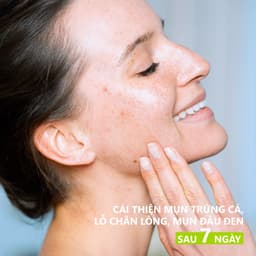 Thumbnail Nước hoa hồng dành cho da hỗn hợp đến da dầu SVR Sebiaclear Micro Peel 150ml 4