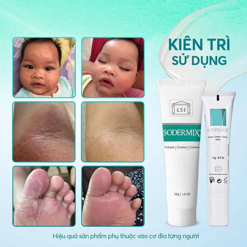 Ảnh 2 SODERMIX 15g - Tặng Kem Helia - Kem Bôi Viêm Da Cơ Địa Hỗ Trợ Ngứa Ngáy, Eczema, Chàm Sữa, Tổ Đỉa, Dưỡng Ẩm 2