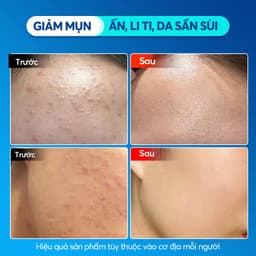 Thumbnail Gel Giảm Mụn Sahemul Sensitive Giảm Mụn Viêm, Mụn Ẩn, Mụn Đầu Đen 20gr [TẶNG KEM MỤN 10GR] 1